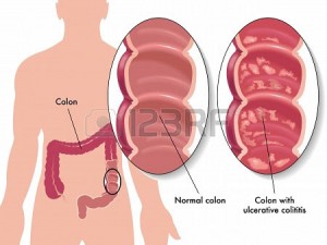colite-ulcereuse