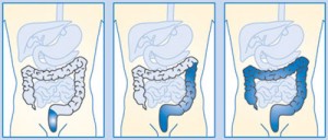 colitisausdehnung