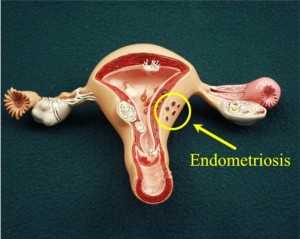 Endometriosis1