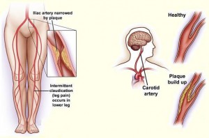 Hyperlipidemia-Symptoms