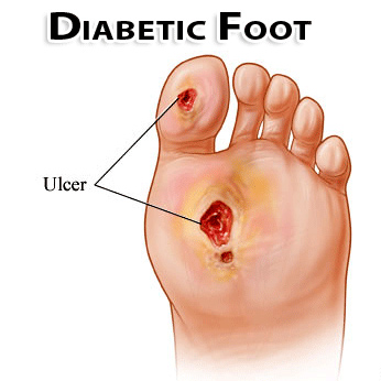 diabetic-foot