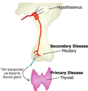 hypothyroidism-1