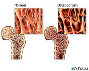 osteoporoz