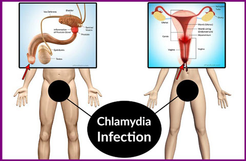 chlamydia-1