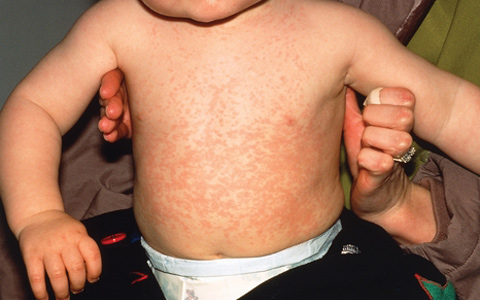 Measles_Baby